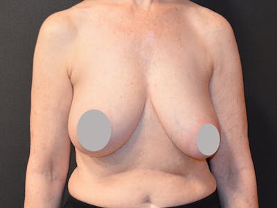 Breast Lift Before & After Gallery - Patient 167355602 - Image 1