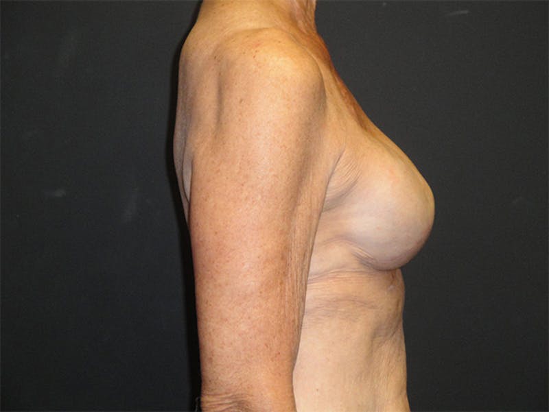 Breast Implant Reconstruction Before & After Gallery - Patient 167355598 - Image 6