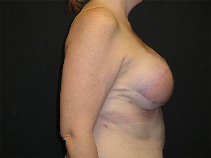 Breast Flap Reconstruction Before & After Gallery - Patient 167355599 - Image 6