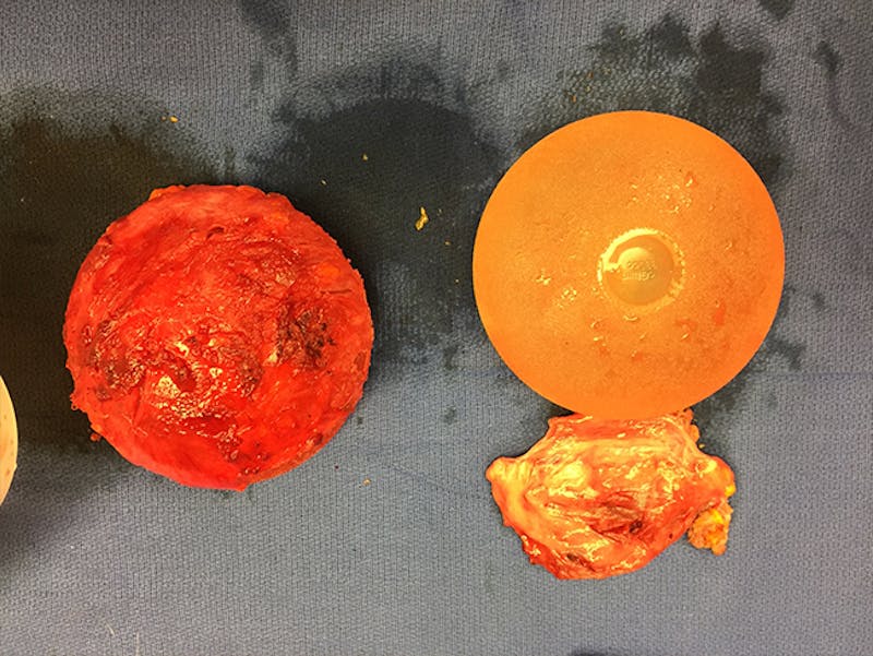 Breast Implant Removal Before & After Gallery - Patient 167355601 - Image 5