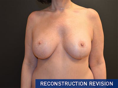 Breast Revision Before & After Gallery - Patient 167355603 - Image 2