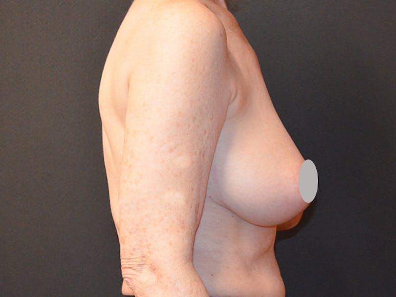 Breast Lift Before & After Gallery - Patient 167355602 - Image 3