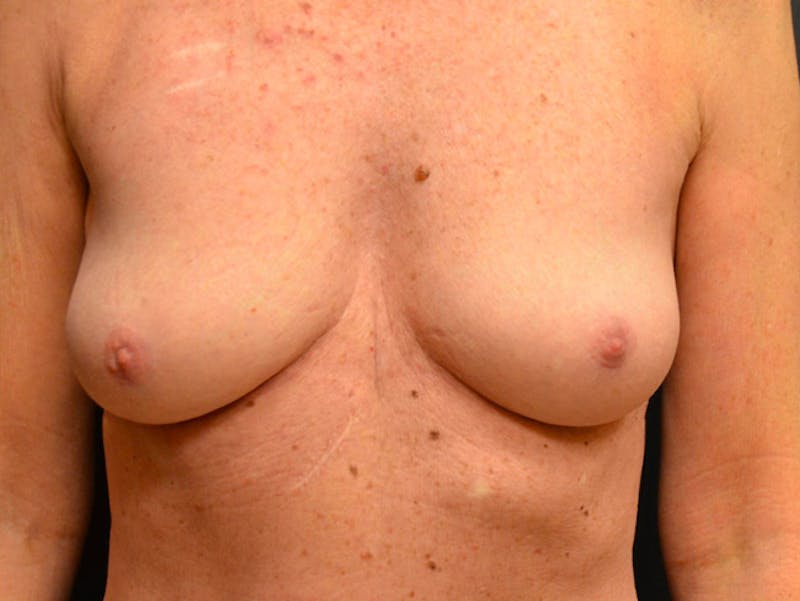 Nipple Correction Before & After Gallery - Patient 167355609 - Image 2
