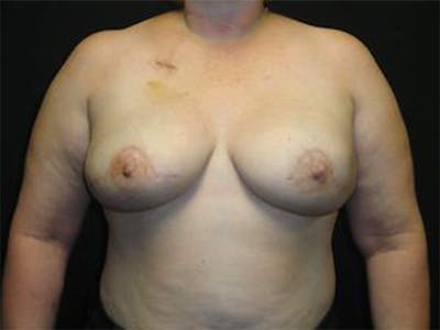 Breast Implant Reconstruction Before & After Gallery - Patient 167355610 - Image 2
