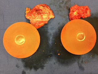 Breast Implant Removal Before & After Gallery - Patient 167355601 - Image 6