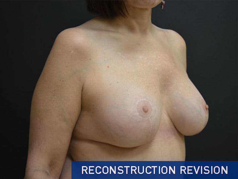 Breast Revision Before & After Gallery - Patient 167355603 - Image 4