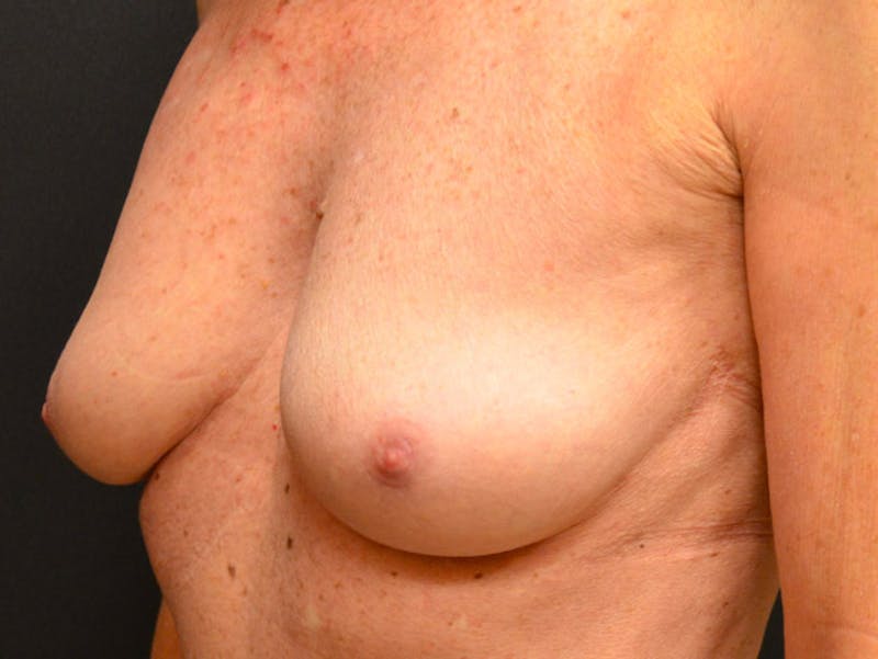 Nipple Correction Before & After Gallery - Patient 167355609 - Image 4