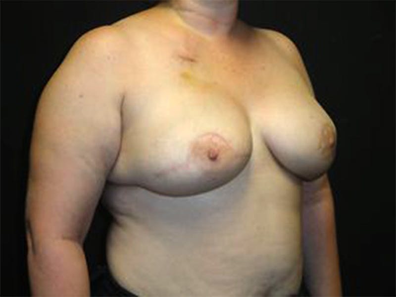 Breast Implant Reconstruction Before & After Gallery - Patient 167355610 - Image 4