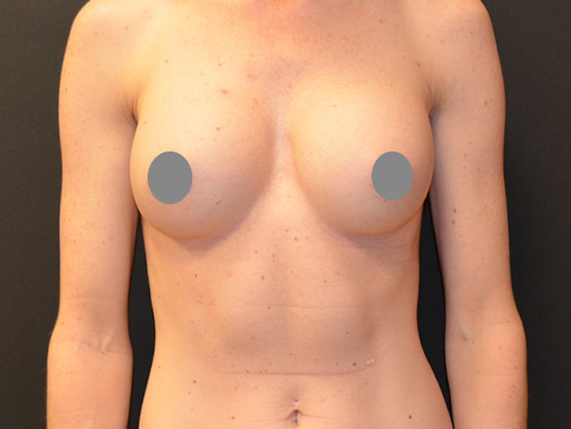 Breast Implant Removal Before & After Gallery - Patient 167355631 - Image 1
