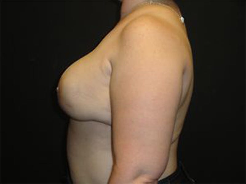 Breast Implant Reconstruction Before & After Gallery - Patient 167355610 - Image 6