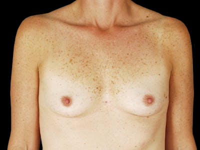 Breast Flap Reconstruction Before & After Gallery - Patient 167355630 - Image 1