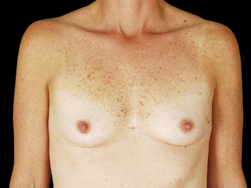 Breast Flap Reconstruction Before & After Gallery - Patient 167355630 - Image 1