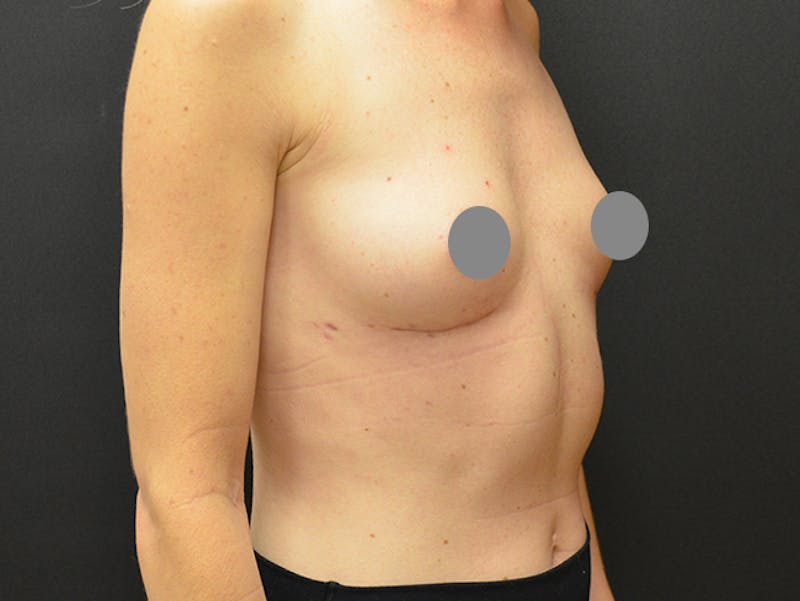 Breast Implant Removal Before & After Gallery - Patient 167355631 - Image 4