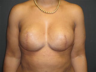 Breast Implant Reconstruction Before & After Gallery - Patient 167355633 - Image 2