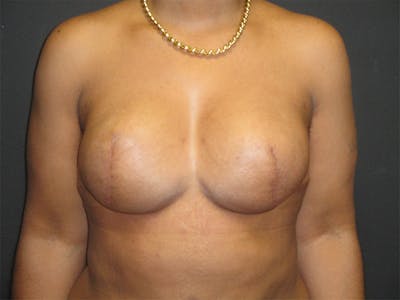 Breast Implant Reconstruction Before & After Gallery - Patient 167355633 - Image 2