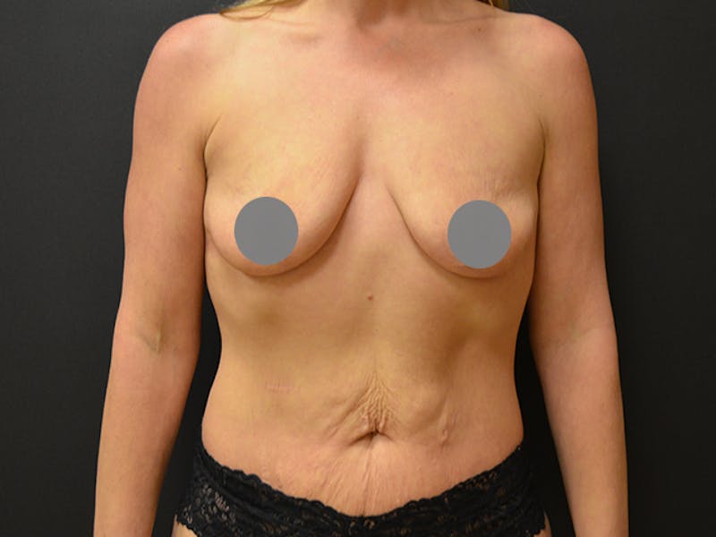 Breast Augmentation Before & After Gallery - Patient 167355640 - Image 1
