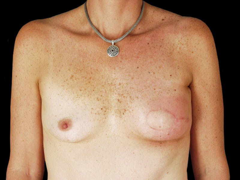 Breast Flap Reconstruction Before & After Gallery - Patient 167355630 - Image 2