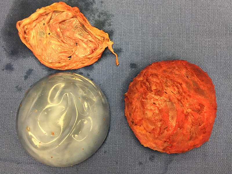 Breast Implant Removal Before & After Gallery - Patient 167355631 - Image 5