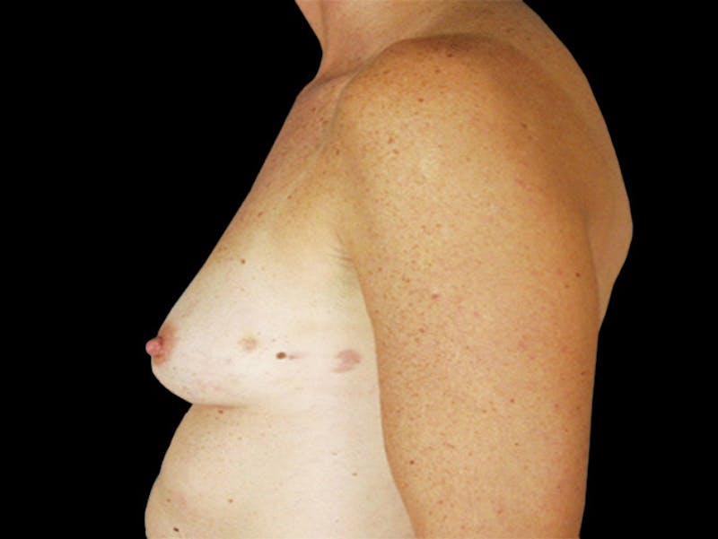 Breast Flap Reconstruction Before & After Gallery - Patient 167355630 - Image 3