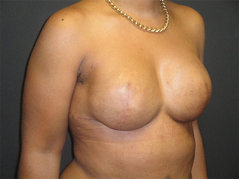 Breast Implant Reconstruction Before & After Gallery - Patient 167355633 - Image 4