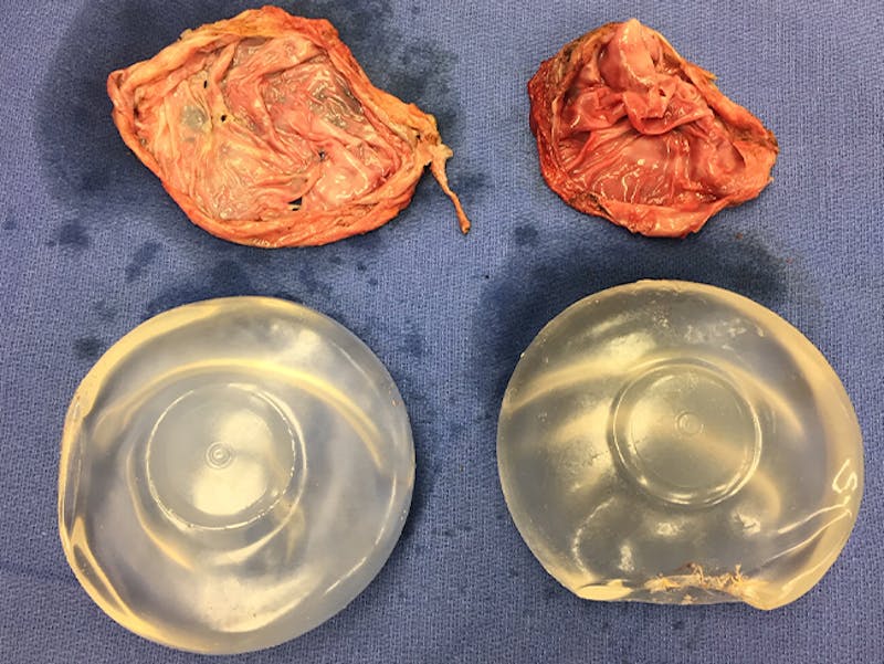 Breast Implant Removal Before & After Gallery - Patient 167355631 - Image 6
