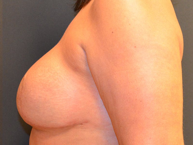Breast Revision Before & After Gallery - Patient 167355639 - Image 6