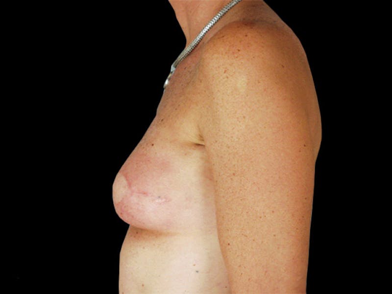 Breast Flap Reconstruction Before & After Gallery - Patient 167355630 - Image 4