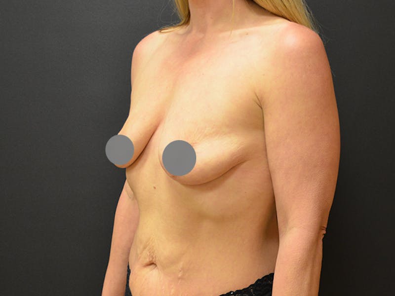 Breast Augmentation Before & After Gallery - Patient 167355640 - Image 3