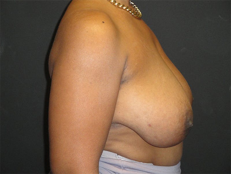 Breast Implant Reconstruction Before & After Gallery - Patient 167355633 - Image 5