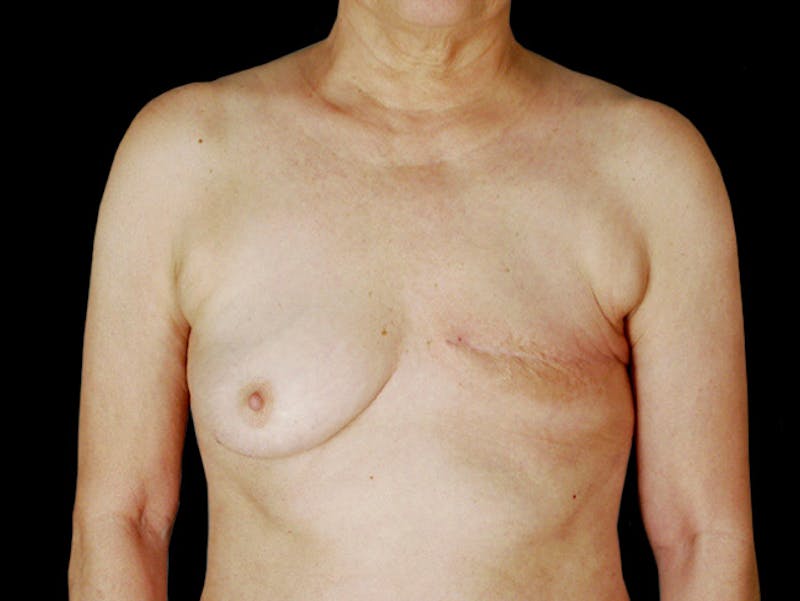 Breast Flap Reconstruction Before & After Gallery - Patient 167355634 - Image 1
