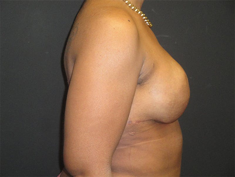 Breast Implant Reconstruction Before & After Gallery - Patient 167355633 - Image 6