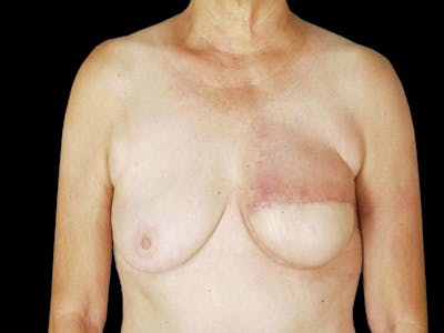 Breast Flap Reconstruction Before & After Gallery - Patient 167355634 - Image 2