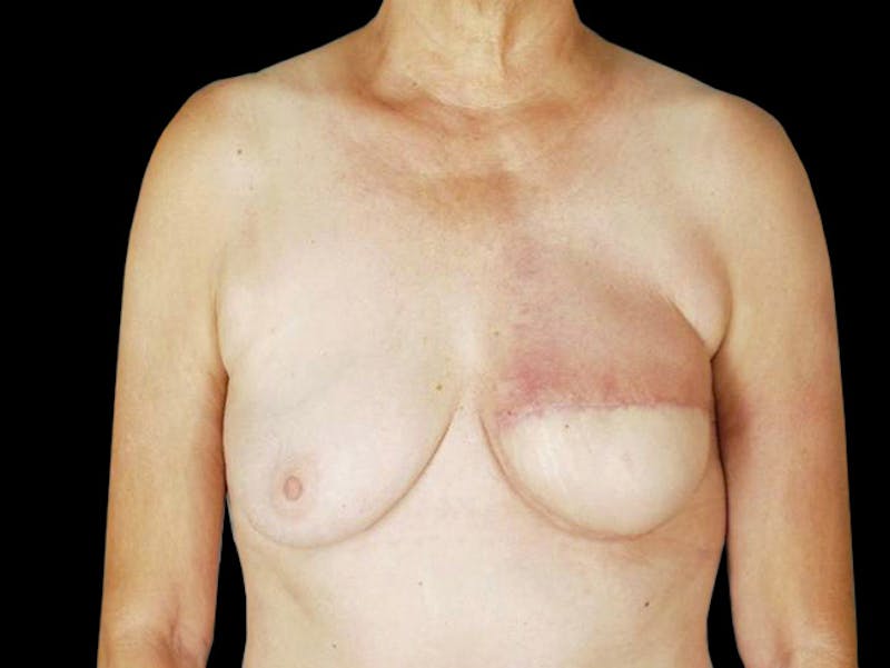 Breast Flap Reconstruction Before & After Gallery - Patient 167355634 - Image 2