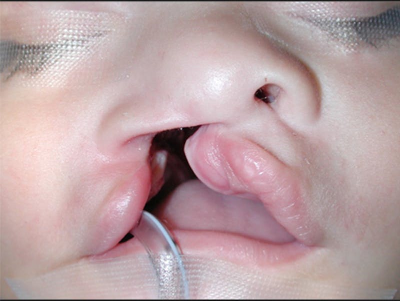 Cleft Lip Before & After Gallery - Patient 167355643 - Image 1