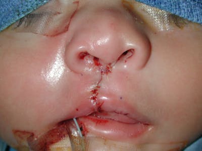 Cleft Lip Before & After Gallery - Patient 167355643 - Image 2