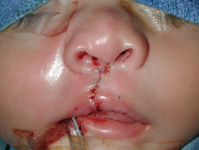 Cleft Lip Before & After Gallery - Patient 167355643 - Image 2