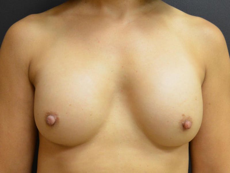 Breast Revision Before & After Gallery - Patient 167355647 - Image 1