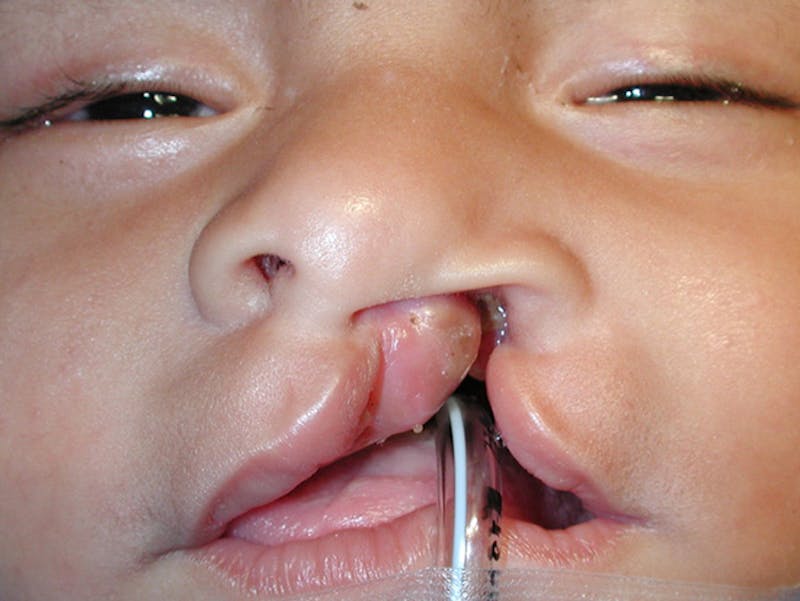 Cleft Lip Before & After Gallery - Patient 167355648 - Image 1