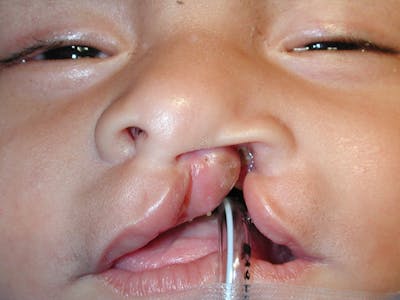 Cleft Lip Before & After Gallery - Patient 167355648 - Image 1