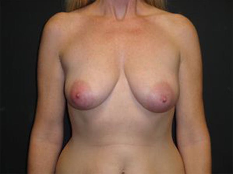 Breast Implant Reconstruction Before & After Gallery - Patient 167355656 - Image 1
