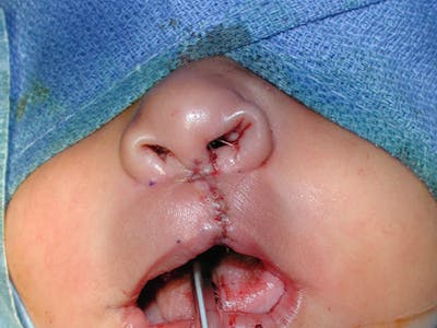 Cleft Lip Before & After Gallery - Patient 167355648 - Image 2