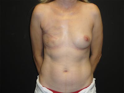 Breast Flap Reconstruction Before & After Gallery - Patient 167355666 - Image 1