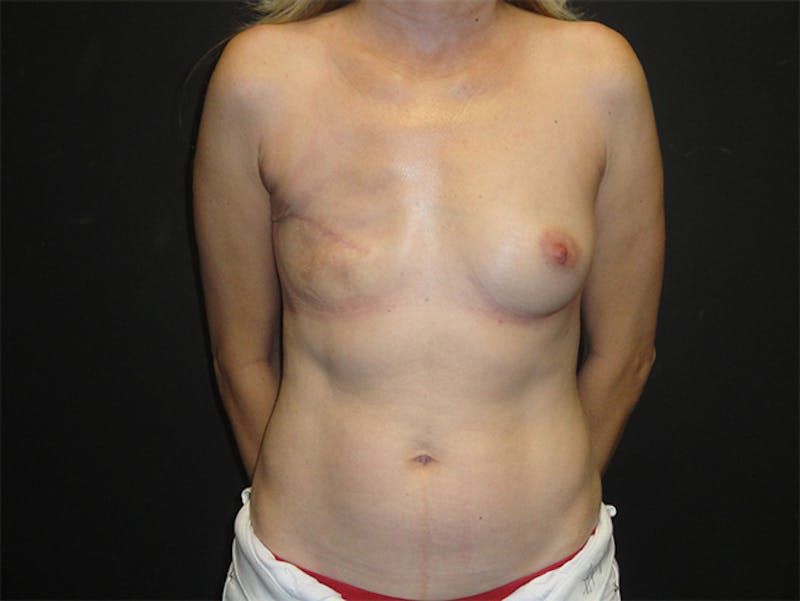 Breast Flap Reconstruction Before & After Gallery - Patient 167355666 - Image 1