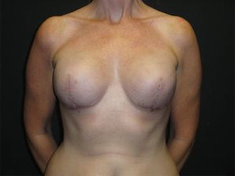 Breast Implant Reconstruction Before & After Gallery - Patient 167355656 - Image 2