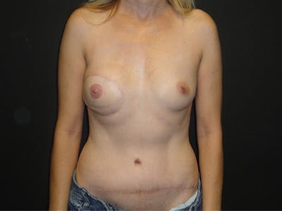 Breast Flap Reconstruction Before & After Gallery - Patient 167355666 - Image 2