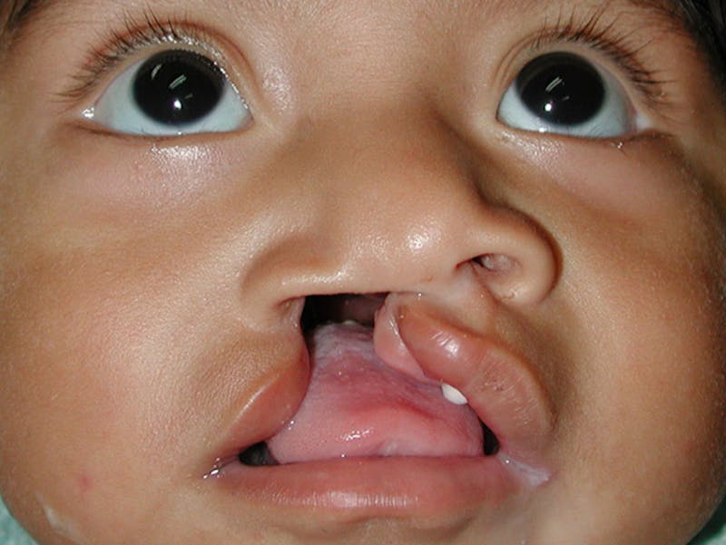 Cleft Lip Before & After Gallery - Patient 167355657 - Image 1