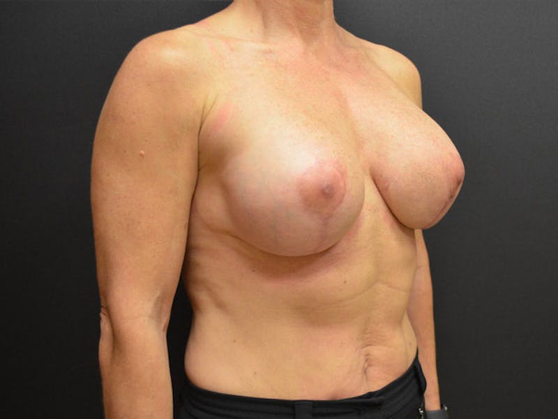 Breast Revision Before & After Gallery - Patient 167355659 - Image 2