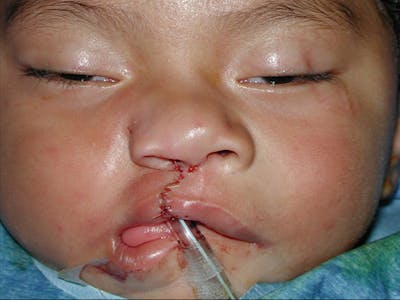 Cleft Lip Before & After Gallery - Patient 167355657 - Image 2