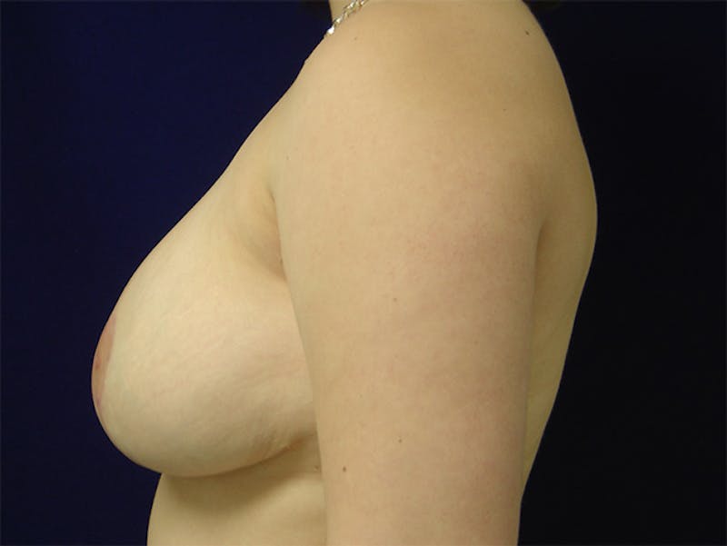 Nipple Correction Before & After Gallery - Patient 167355658 - Image 4
