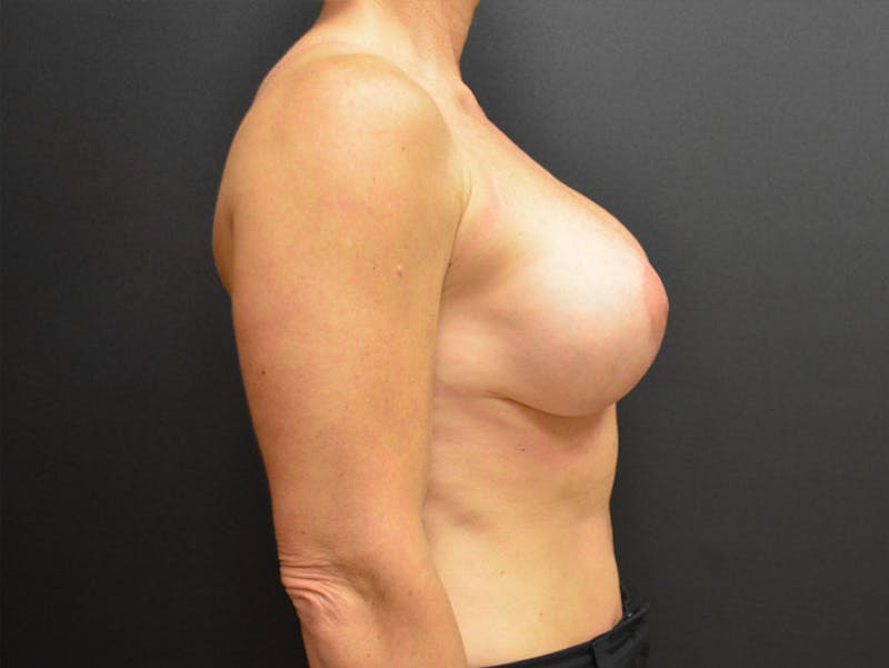 Breast Revision Before & After Gallery - Patient 167355659 - Image 4